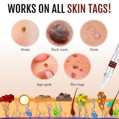 Skin Tag And Mole Remover