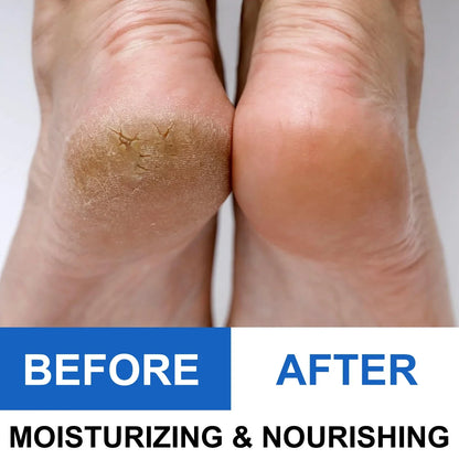Heel Repair Stick For Dry Cracked Heels Fast Relief