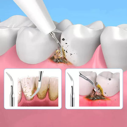 Dental Plaque Remover Tool