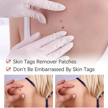 Skin Tag And Mole Remover